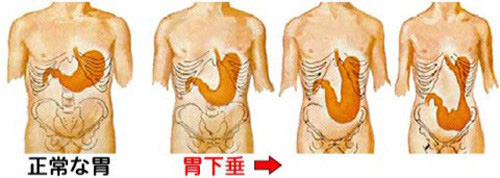 胃下垂のリアル絵
